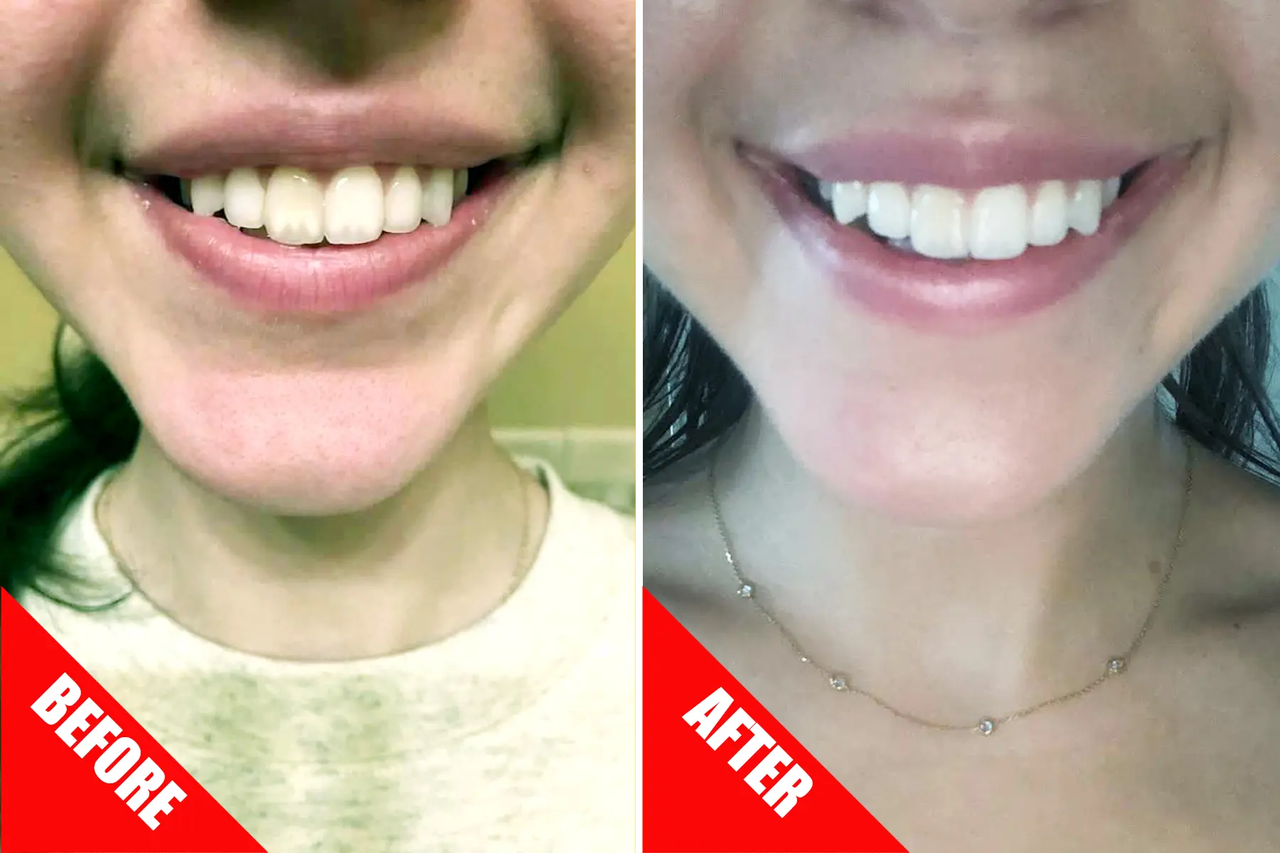 Colgate bago at pagkatapos