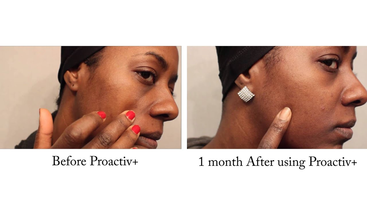 Proactiv לפני ואחרי